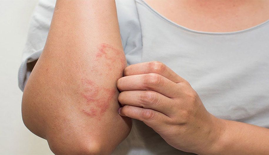 راجب بثورات پوستی بیشتر بدانید راجب بثورات پوستی بیشتر بدانید