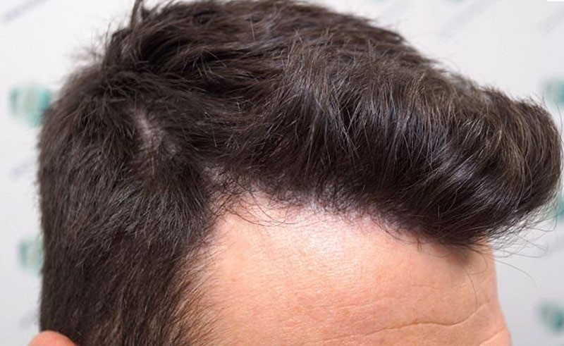 با مزایا و معایب کاشت مو بیشتر آشنا شویم
