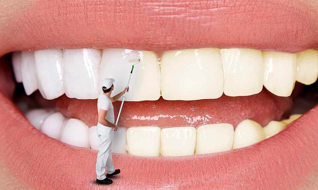 بررسی تفاوت لمینت و کامپوزیت و بلیچینگ بررسی تفاوت لمینت و کامپوزیت و بلیچینگ